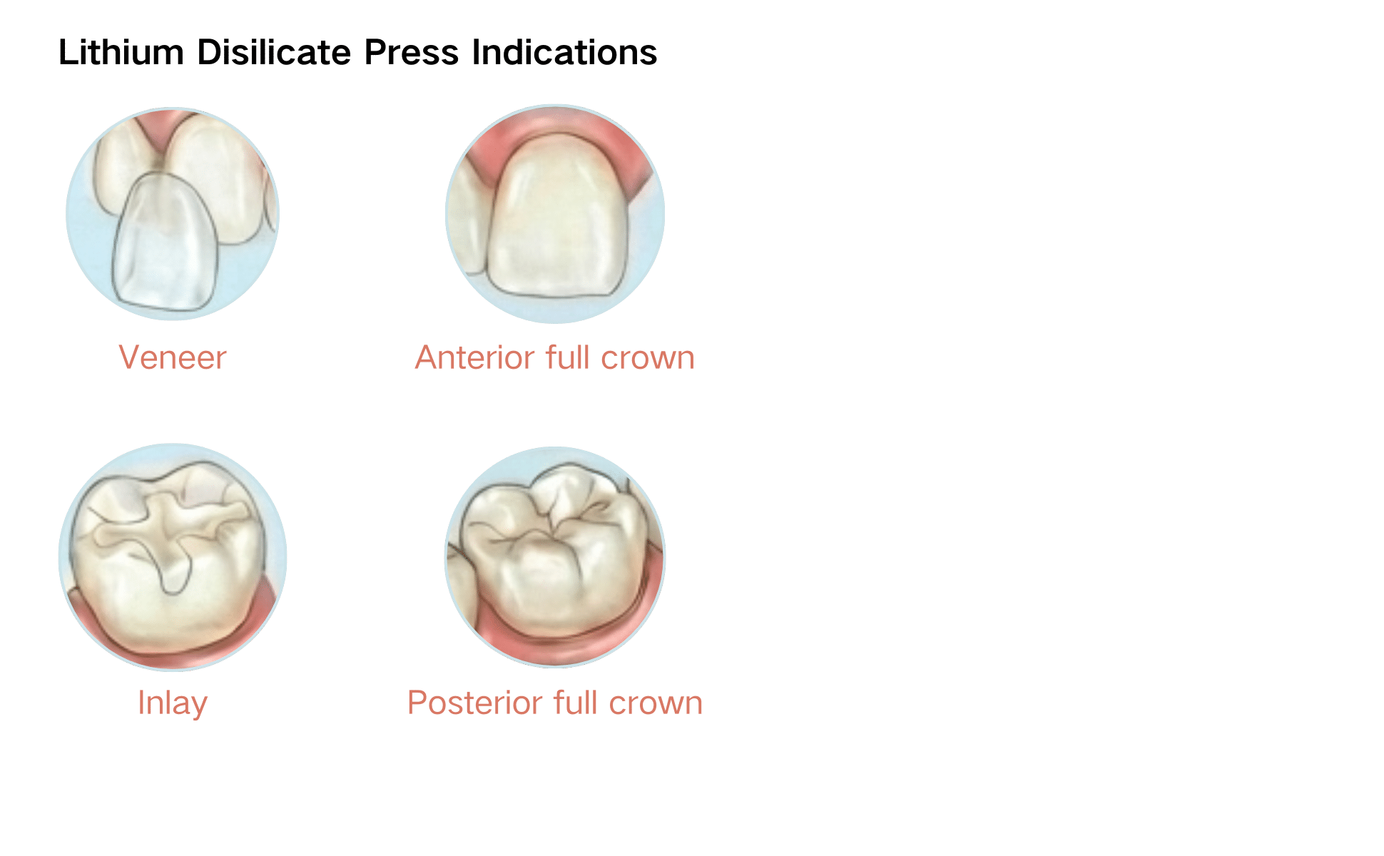 Lithium Disilicate Press Ingots - Clinical indications chart showing crown, bridge, veneer and inlay applications
